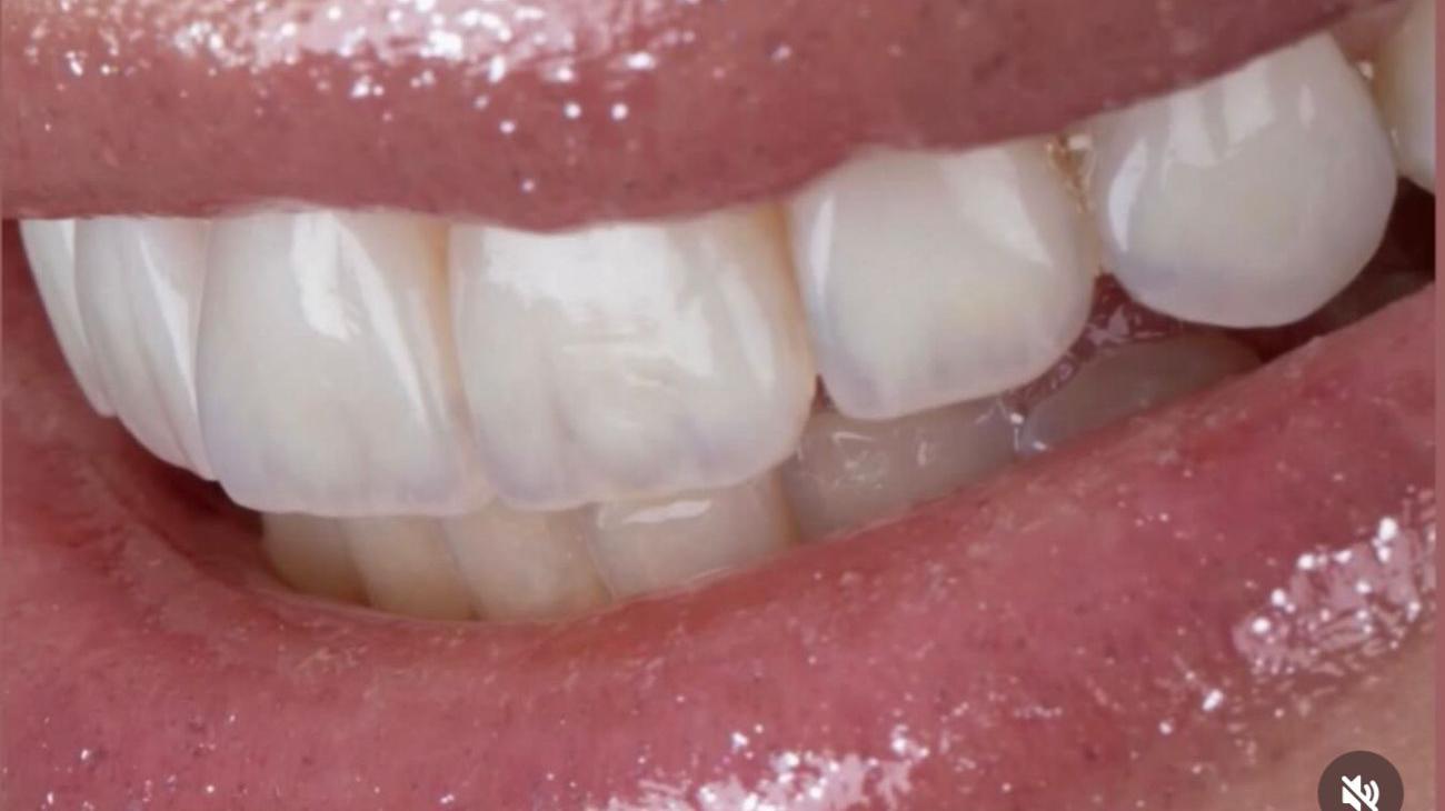 After Cosmetic Dentistry