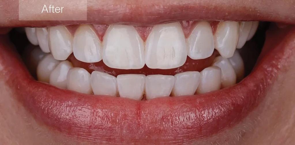After Clear Aligners
