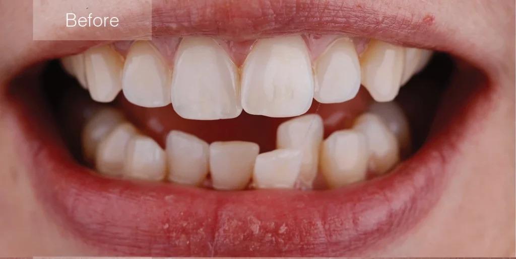 Before Clear Aligners