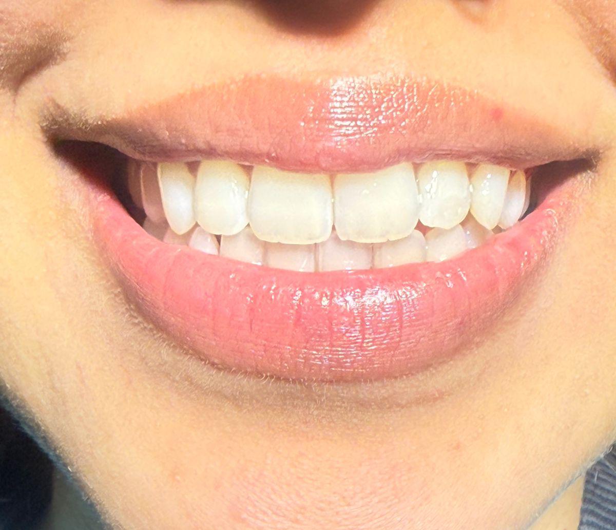 After Ortho Braces
