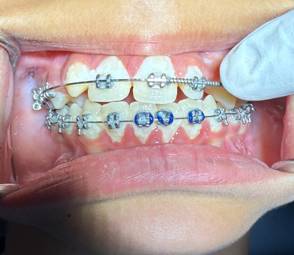 Before Ortho Braces