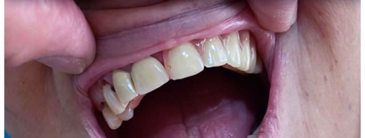 After Dentures