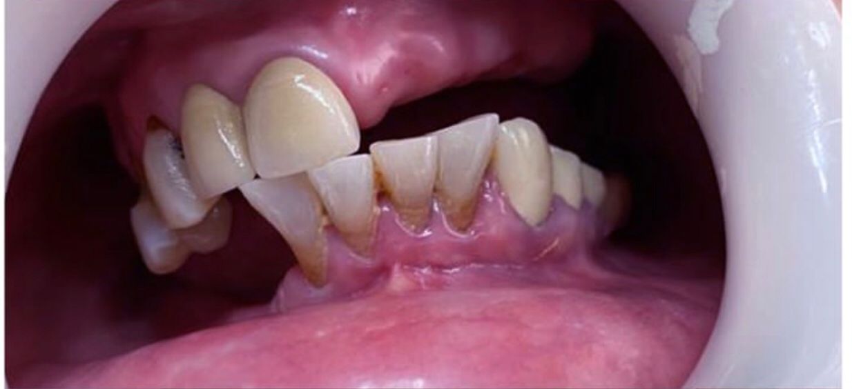 Before Dentures