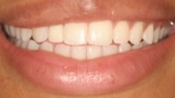 After Dental Implant