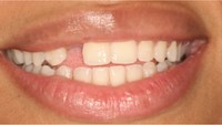Before Dental Implant