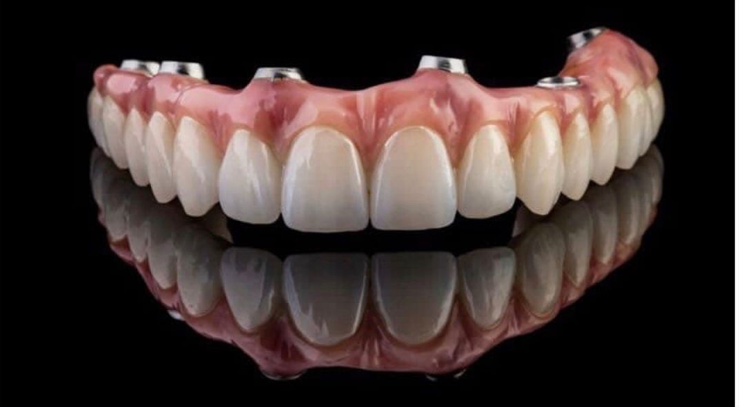 Bone Grafting in Karachi at Najeeb Saad Dental Clinic
