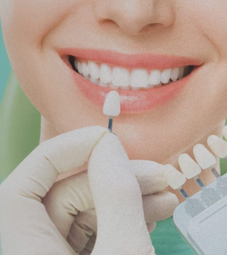 Hollywood Smile Design