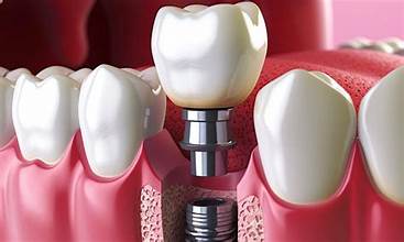 Dental Implants in Karachi at Najeeb Saad Dental Clinic