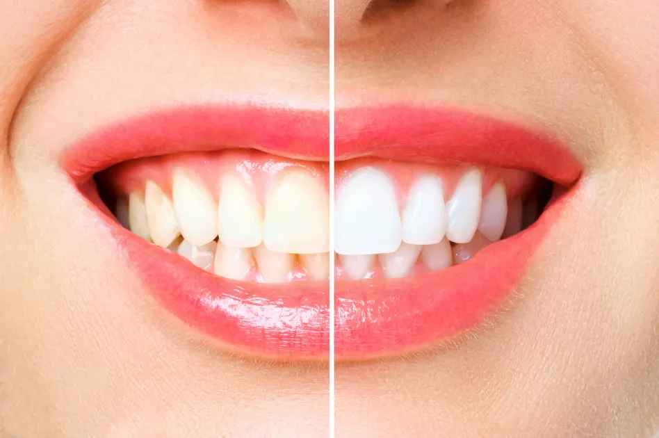 Teeth Whitening in Karachi at Najeeb Saad Dental Clinic