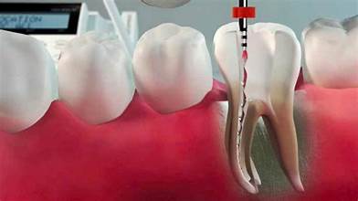 Root Canal in Karachi at Najeeb Saad Dental Clinic