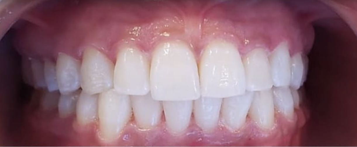 After Whitening