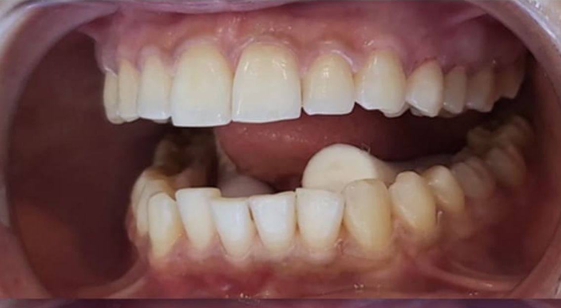 Before Whitening